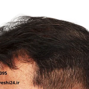 معجزه رویش مجدد مو با قرص هیرونیک